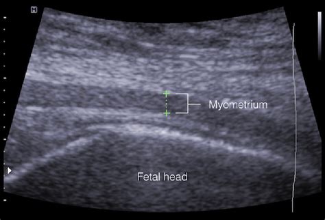 sonographic lower uterine segment thickness